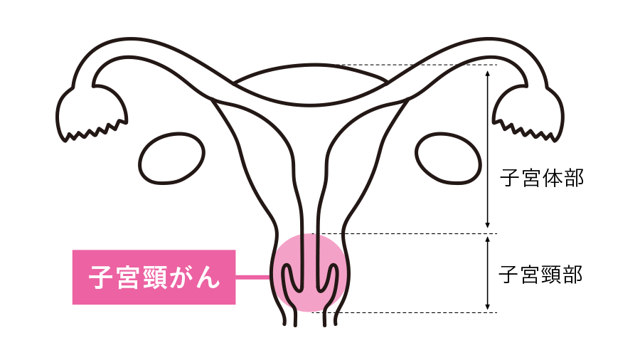 子宮頸がんワクチンの重要性