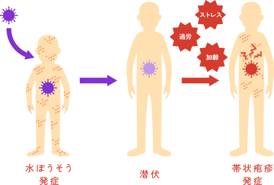 帯状疱疹の初期症状と原因は?予防接種の効果と費用 1 子供の頃の水ぼうそうウイルスが神経節に潜伏し、加齢や免疫力低下によって再び活性化して帯状疱疹を発症するまでの仕組みのイラスト解説