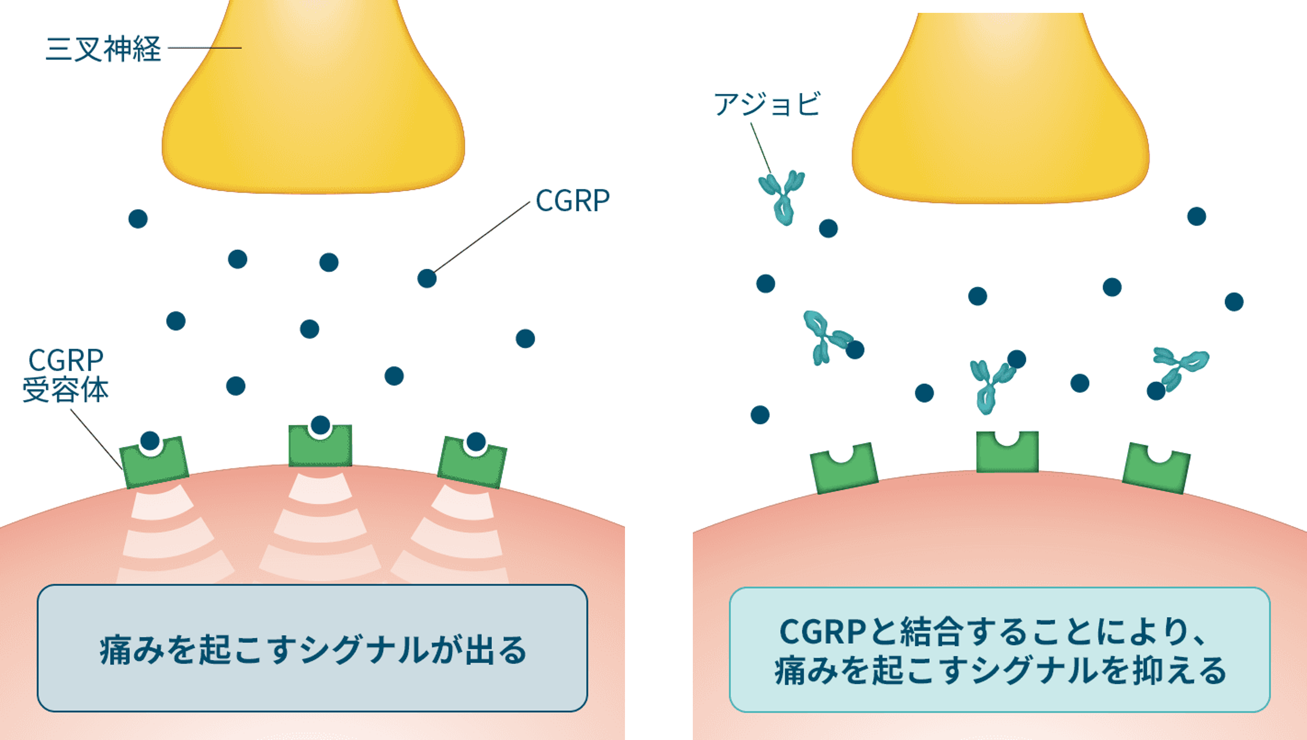 片頭痛が起こる仕組みとCGRP関連抗体薬（アジョビ）が痛みのシグナルを抑えるメカニズム of 解説イラスト